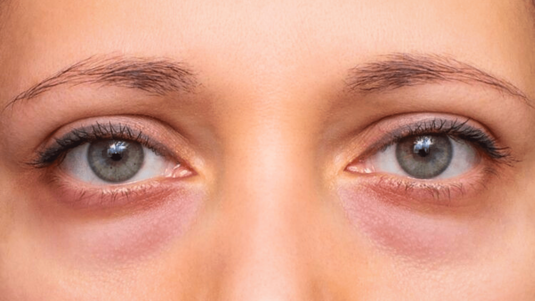 Why Poor Sleep Causes Eye Puffiness and Dark Circles