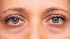 Why Poor Sleep Causes Eye Puffiness and Dark Circles