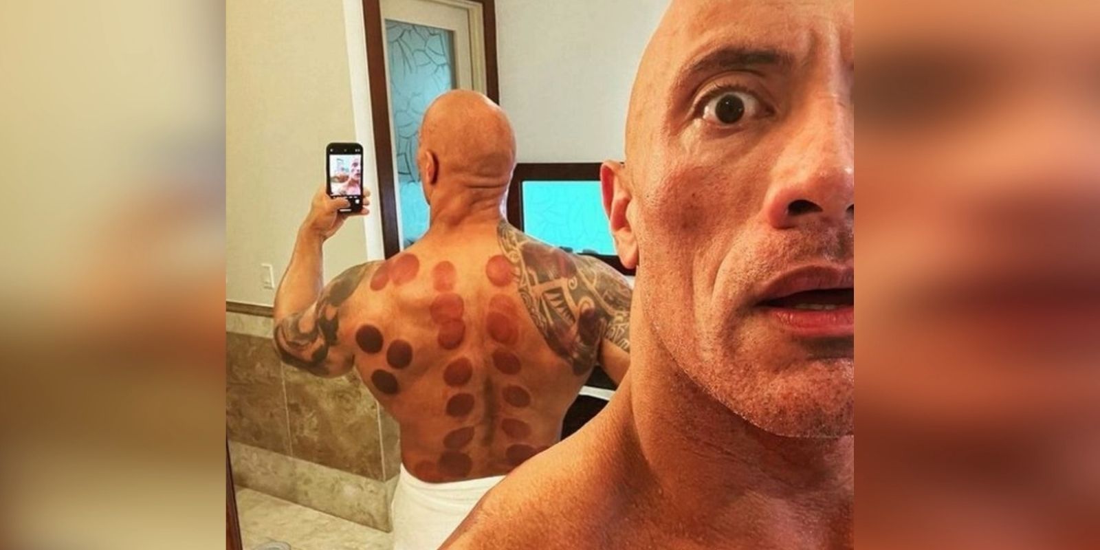 Dwayne Johnson 'The Rock' gets Cupping Therapy