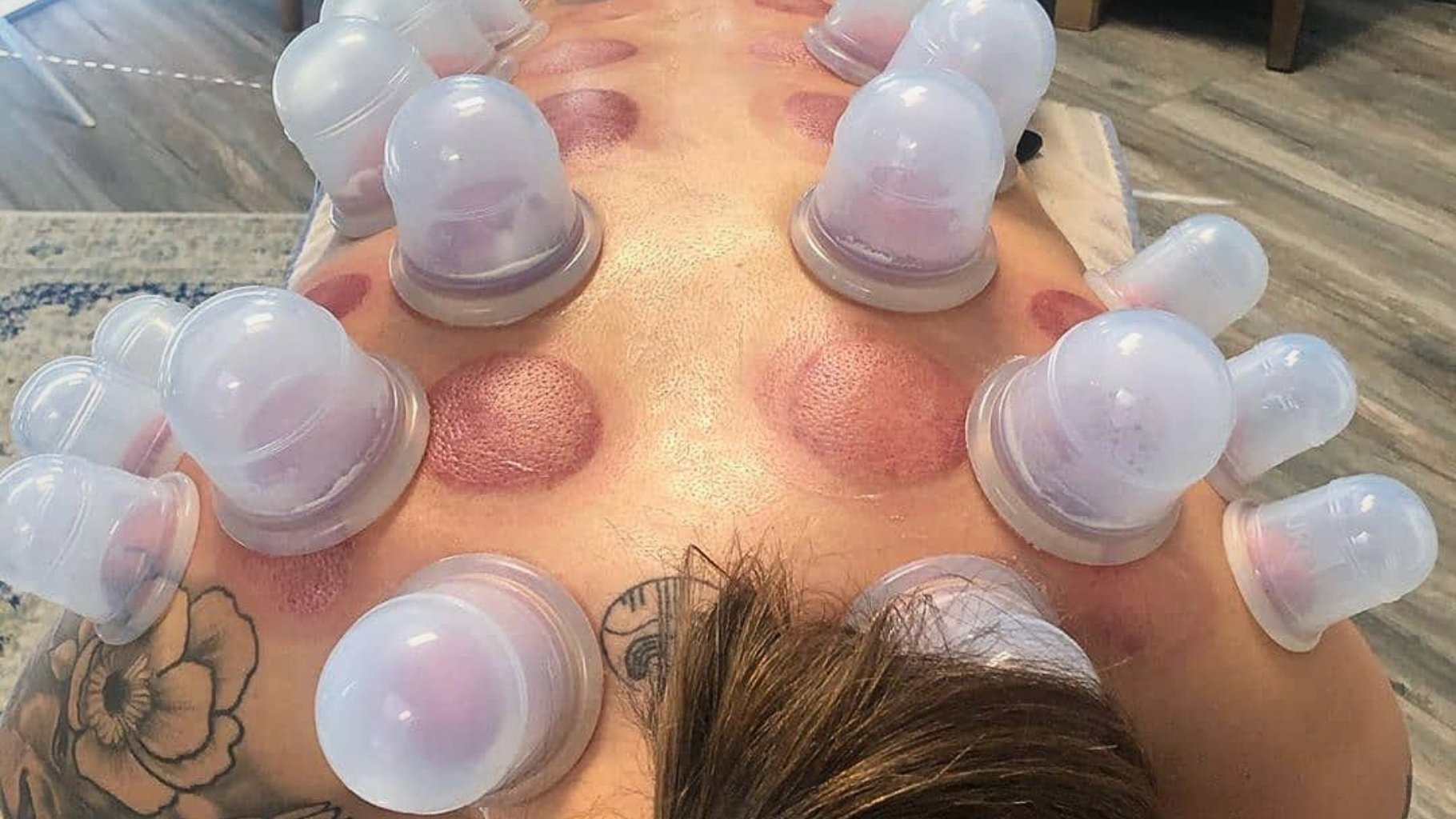 Cupping for Muscle Pain and Fascia Tightness: What to Know