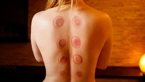 Does Cupping Really Work? A Look at the Science