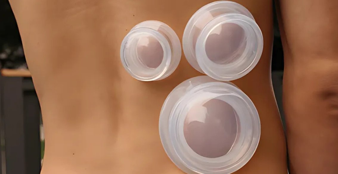 Cupping for Lower Back Pain and Lasting Back Relief