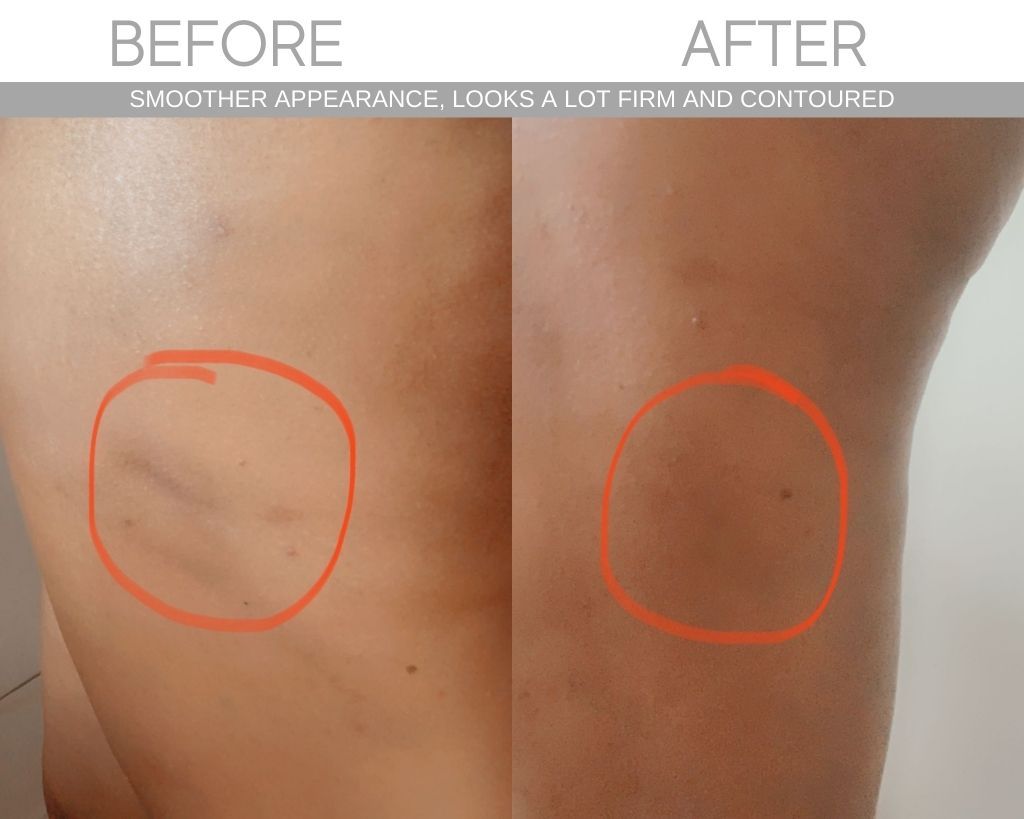 SCULPT Cellulite Cupping Set